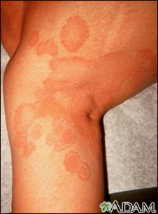 Ringworm - tinea corporis on the leg