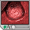 Stomach ulcer