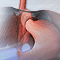 Anti-reflux surgery