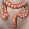 Irritable bowel syndrome