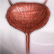 Urinary tract infection - adults