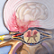 Herniated disk