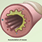 What happens when a person has cystic fibrosis (CF)?