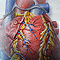 Heart attack