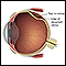 Detached retina
