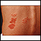 Herpes zoster (shingles) on the back